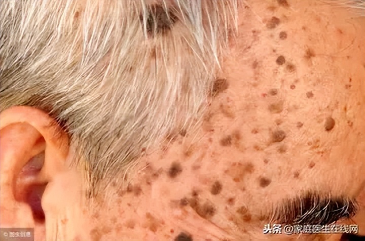 老年色素沉着斑怎么消除,色素沉着老年斑能去除吗