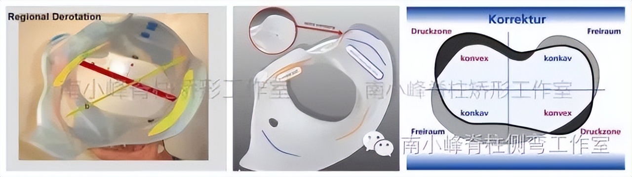 脊柱侧弯出现剃刀背必须手术吗,儿童脊柱侧弯正确的矫正方法