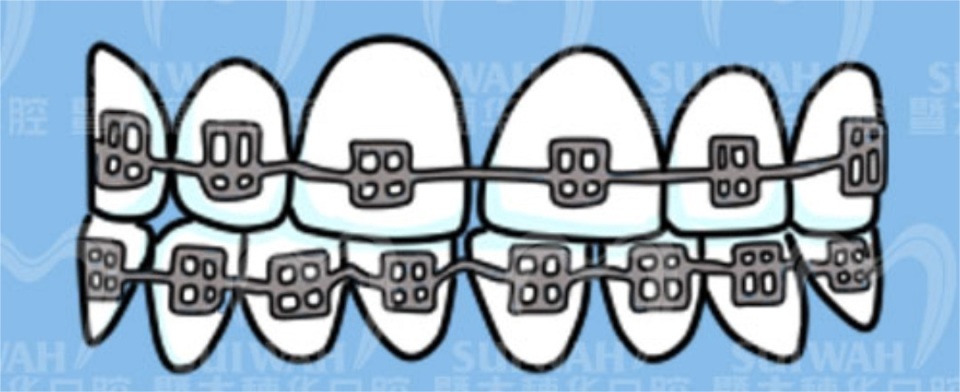 牙齿缝隙越来越大是怎么回事,45岁牙齿缝隙越来越大能矫正吗