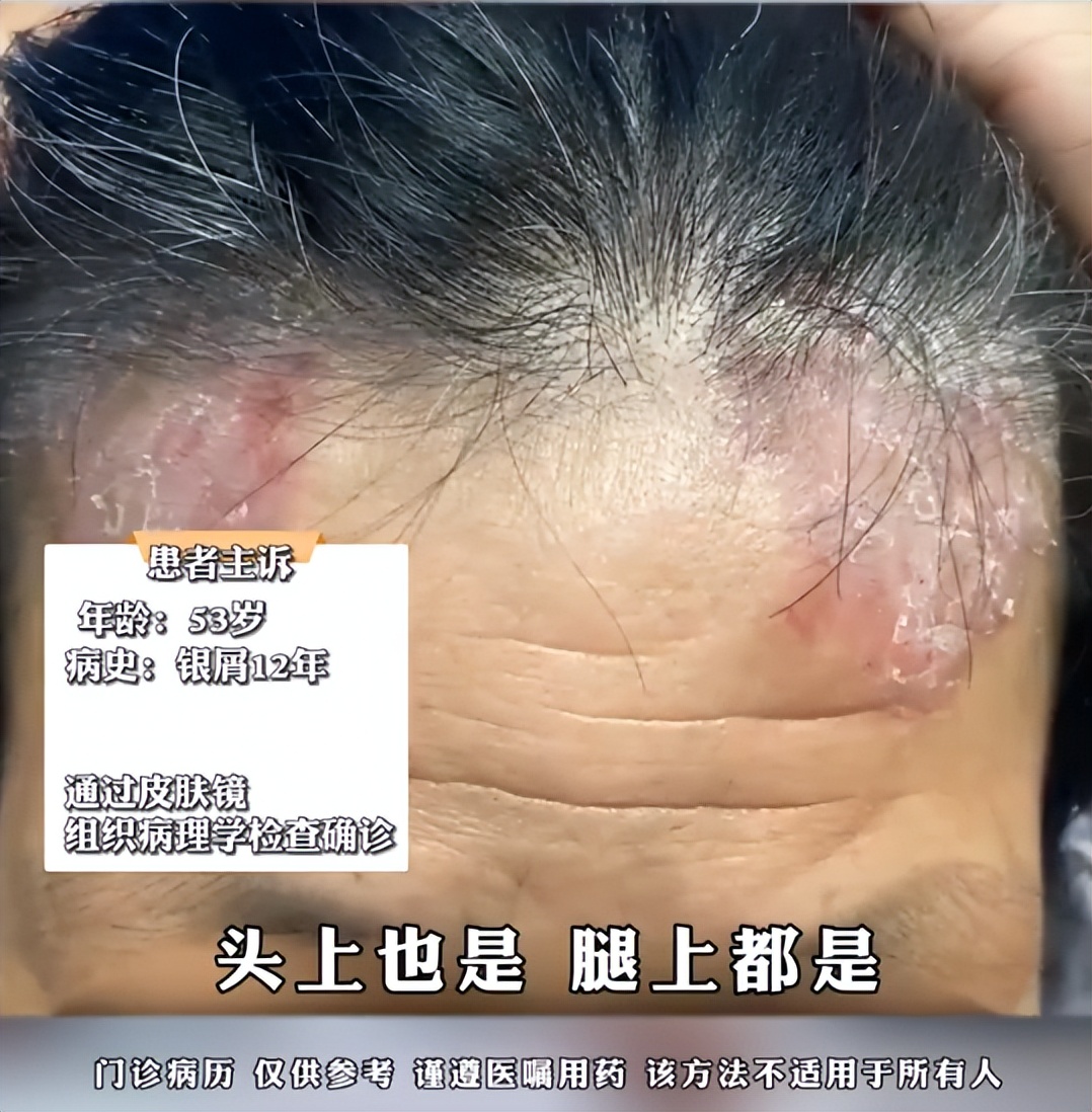 大妈得了牛皮癣,治疗牛皮癣的老太太