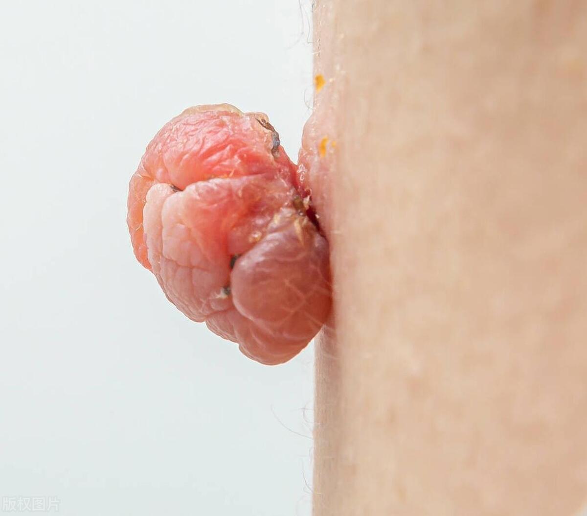 30岁男子有个小癖好：抠“菊花”抠到小肉球，去医检查竟是肛门癌