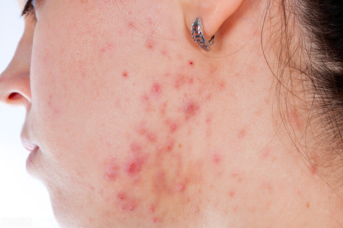 三十多岁还长痘怎么回事,三十多岁长斑长痘怎么办