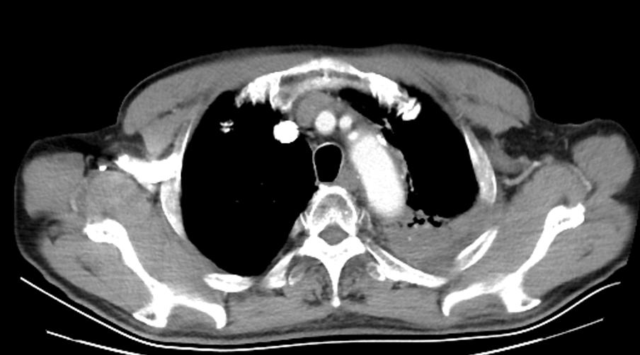 驱动基因阳性早期肺腺癌生存期,肺鳞癌驱动基因阳性比例