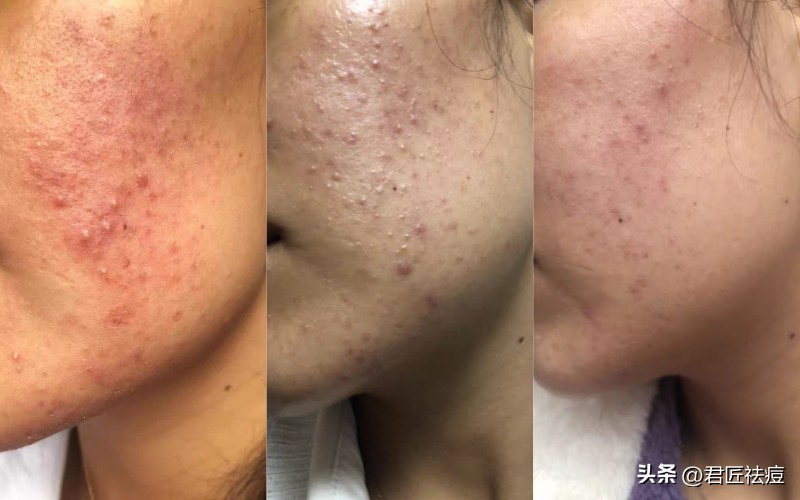 鼻子上长痘痘最快消除的方法,鼻子上长痘痘怎样根治