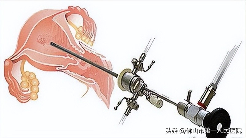 不损伤处女膜，未婚者治疗阴道斜隔综合征有办法