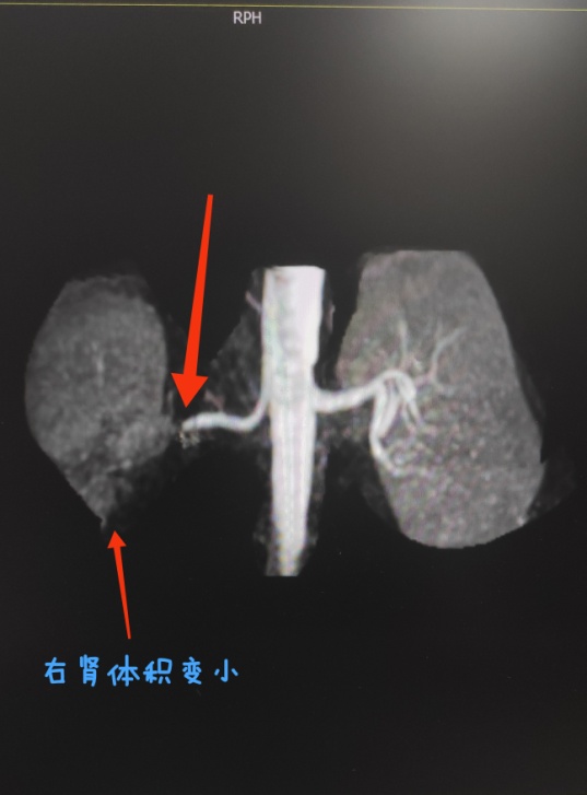 关注青年高血压关注肾动脉狭窄——兰大二院西固医院神经外科成功完成经皮肾动脉狭窄球囊扩张成形术