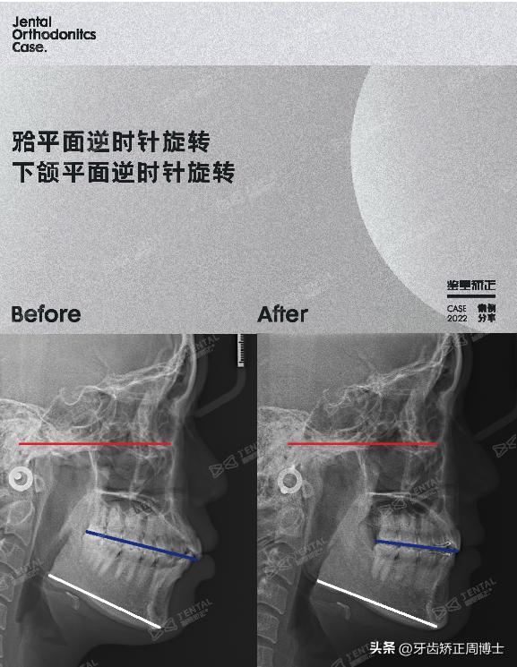 闭嘴巴下巴有核桃纹做什么手术,为什么下巴会有像核桃一样的纹路