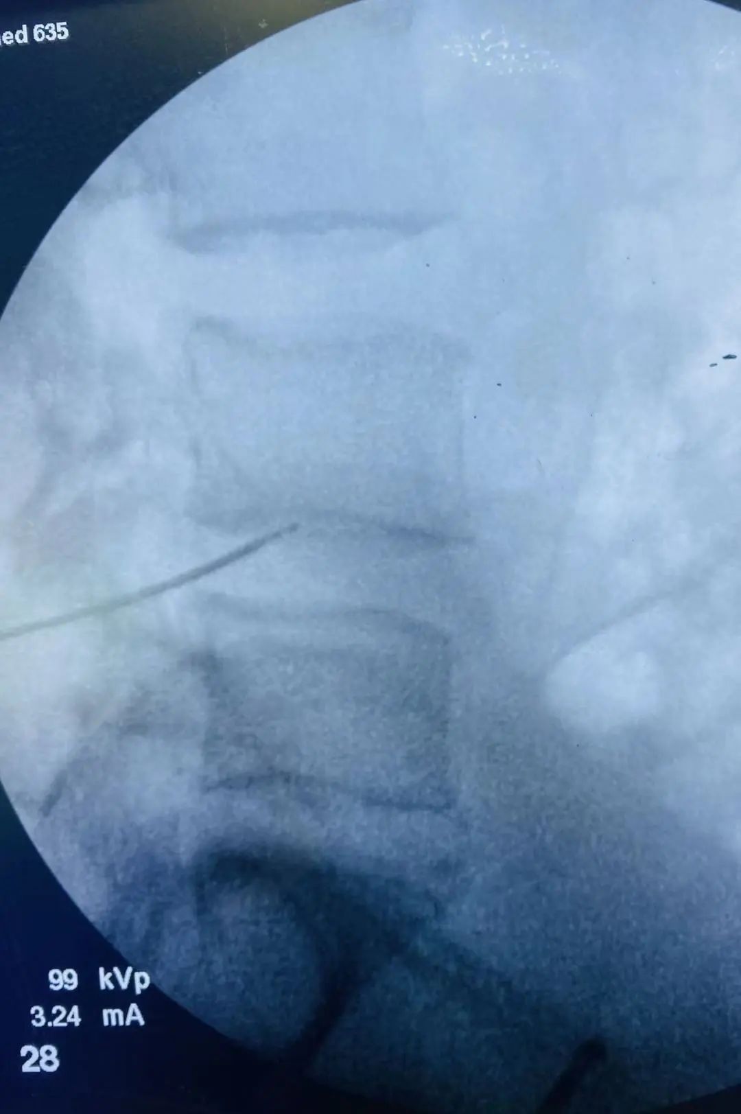 等离子脊柱微创手术,脊柱微创射频消融术