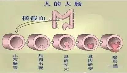 肠长了息肉有什么症状,肠里有息肉是怎么造成的