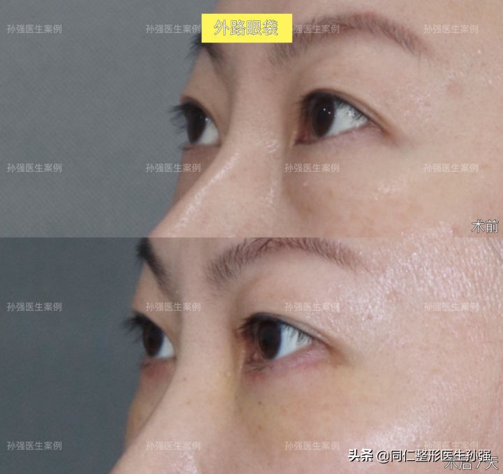 北京医院治眼袋,北京治疗眼袋好的方法