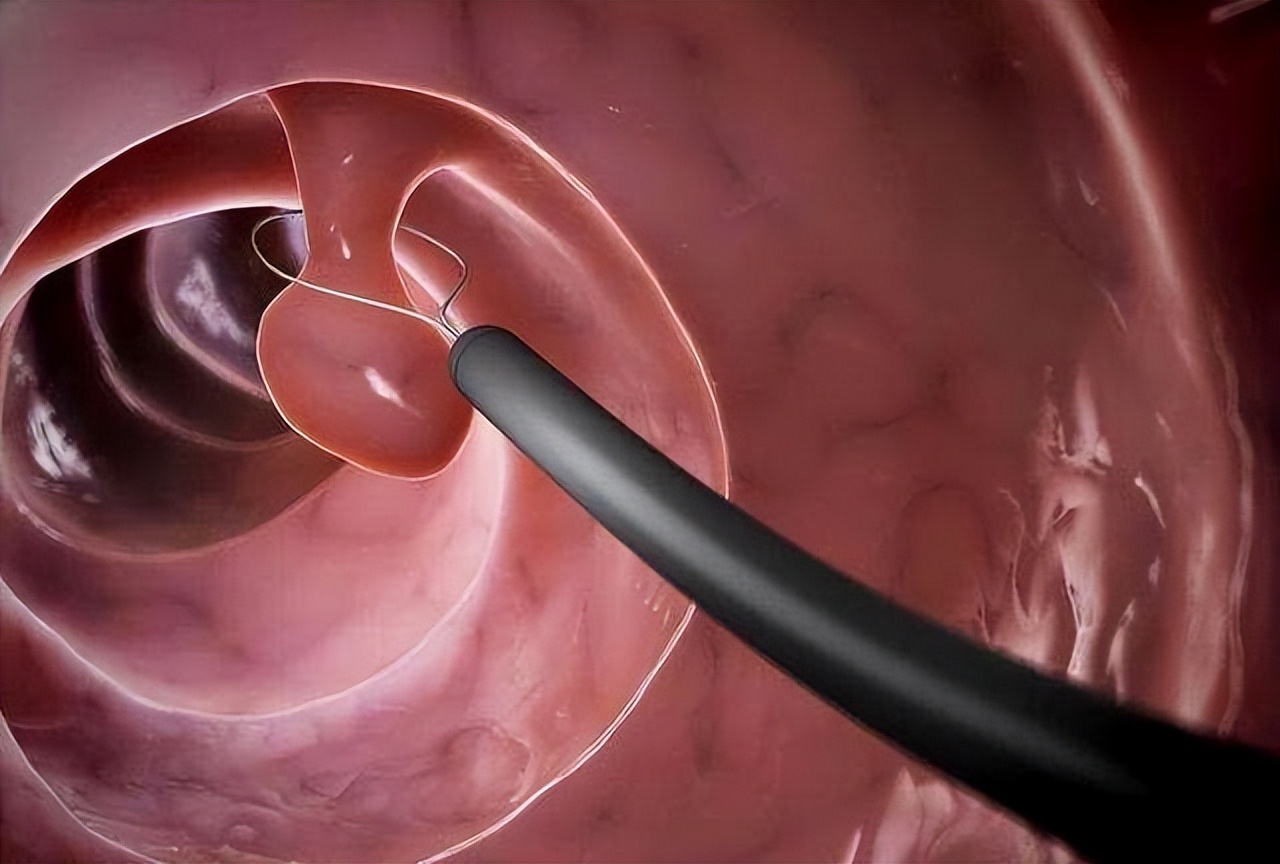 做肠镜是一直疼还是隔多久再做,做一次肠镜有效期可持续多久