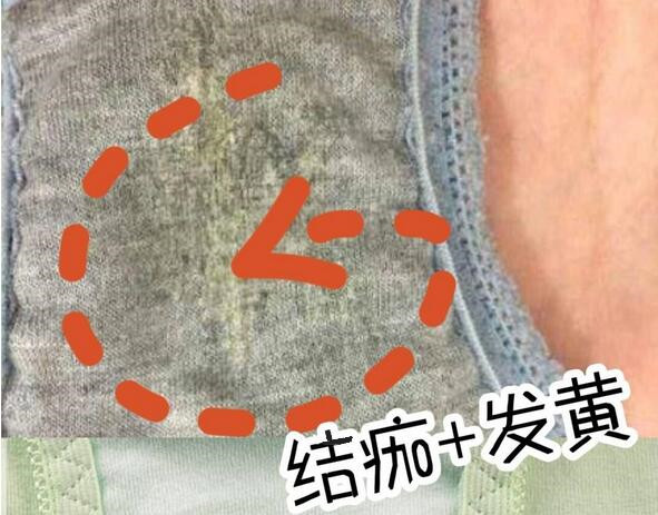 妇科病瘙痒有豆腐渣怎么治念珠菌,阴部有豆腐渣还痒是什么原因