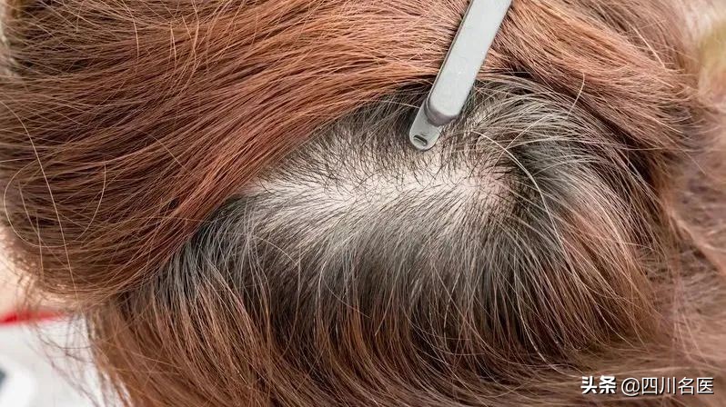 9岁小孩有白发这是缺什么营养素,十二岁儿童长白发缺什么营养