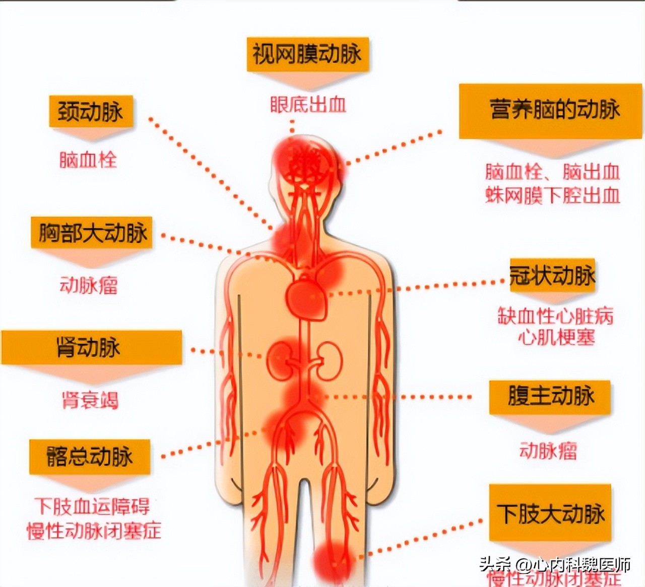 高血压的人低压低是怎么回事,高血压低压超过90低于100