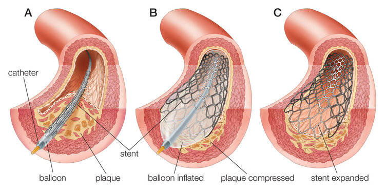 明明放了支架为什么还会堵塞,为什么做了心脏支架会胃大出血
