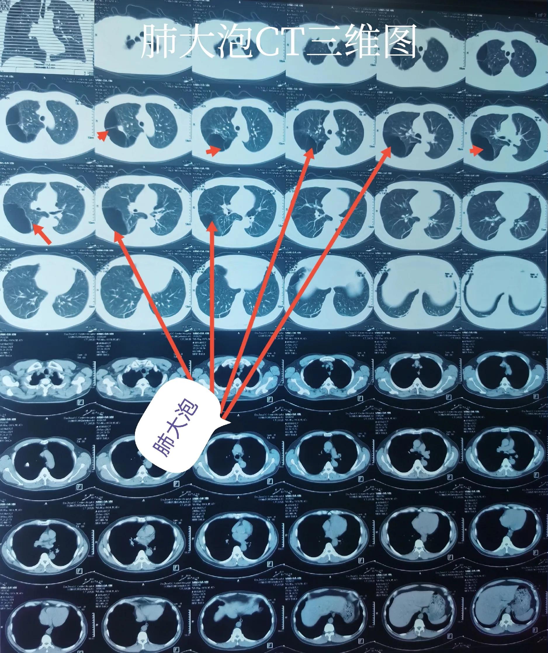 肺大泡产生的原因及治疗方案,肺大泡怎么治疗断根