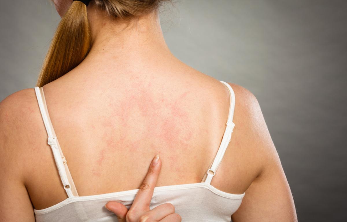 仓鼠咬人全身皮肤变成火龙果事件,杭州一女子买仓鼠得恙虫病