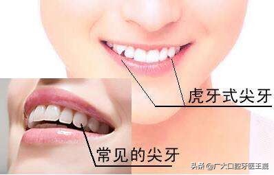 老虎牙矫正最快的方法,老虎牙矫正方法