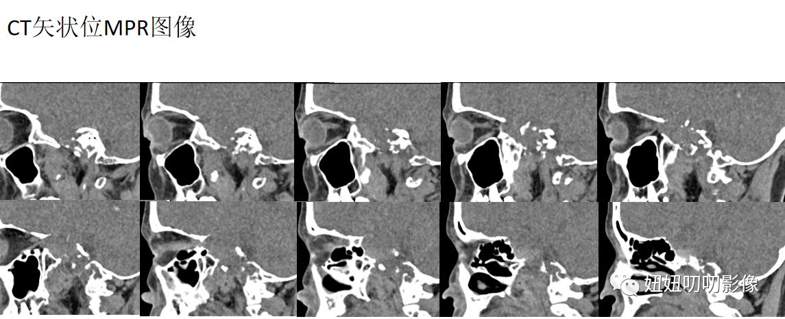 软骨肉瘤mri,骨肉瘤ctmr表现