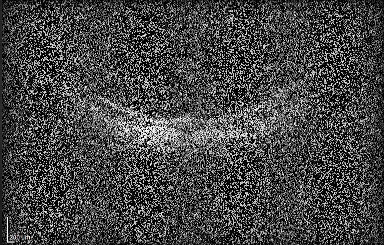 我和来自美国求医的Jason过了一个虚惊一场的父亲节