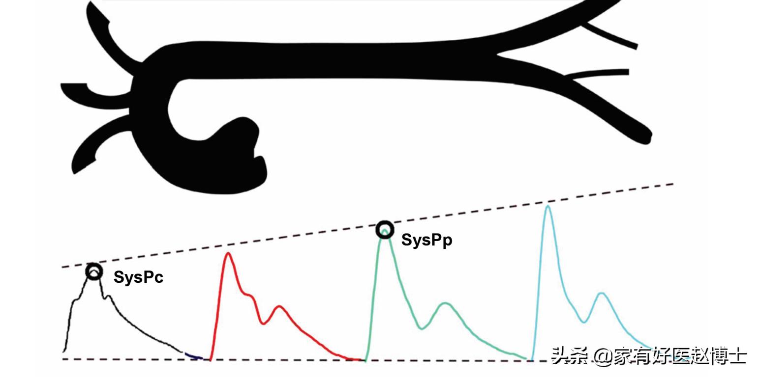 动脉弹性轻度下降怎么办,动脉硬化后动脉弹性下降