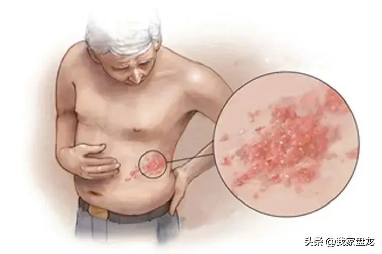 一针带状疱疹疫苗,带状疱疹与老年痴呆的关系