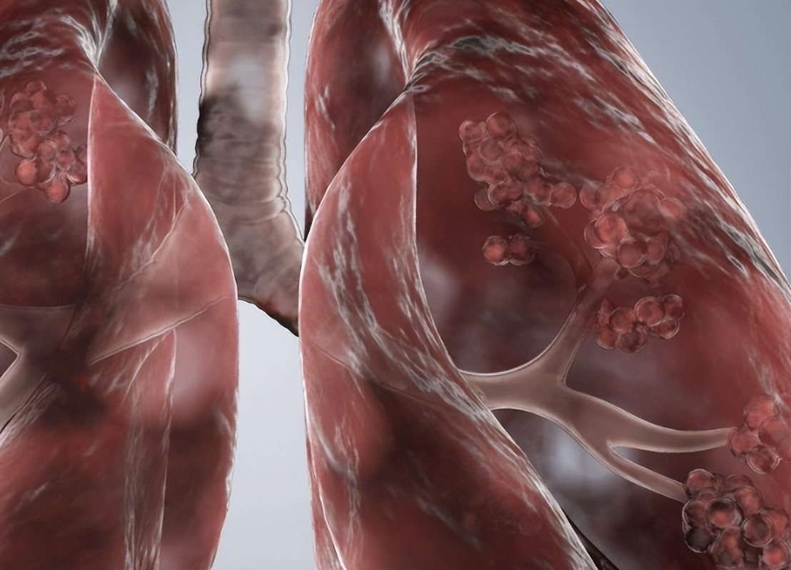 胸腔镜下胸膜冷冻活检，在胸腔积液诊断中，有价值和安全性么