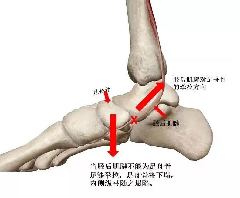 扁平足发病机制,扁平足诊断标准示意图