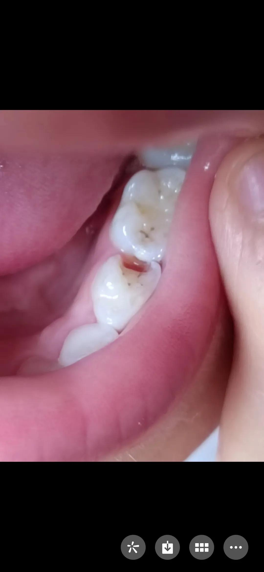 昨天带着外孙女去补了牙，顺便也把一只松动的门牙给拔掉了