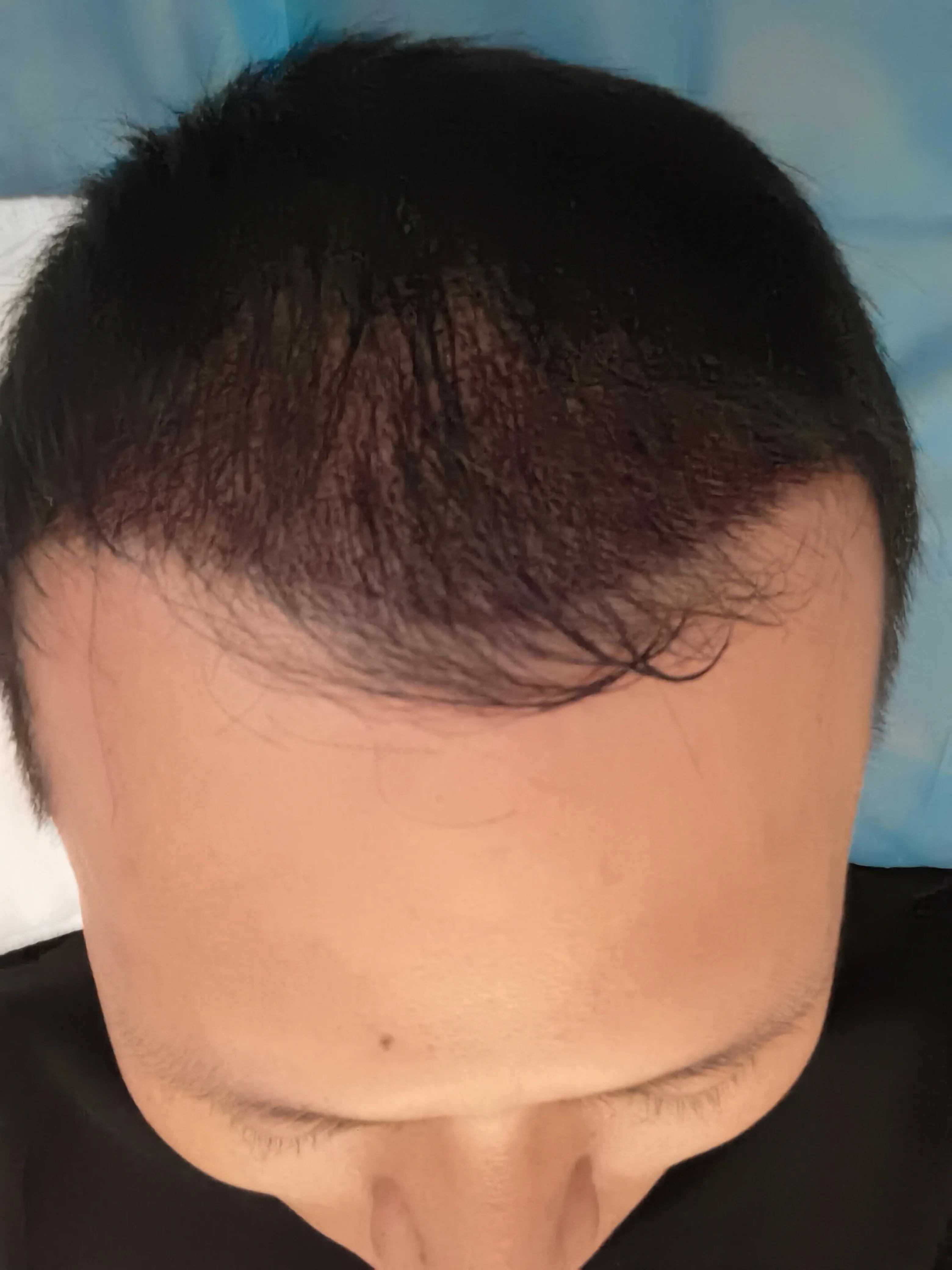 男士植发过来人真实感受,16000字讲述植发真实感受