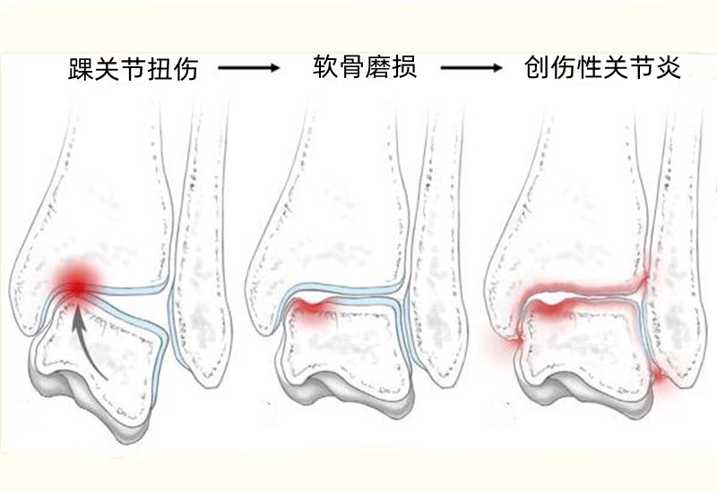 两年前崴过脚这几天突然疼,十年以前崴了脚现在还痛怎么办