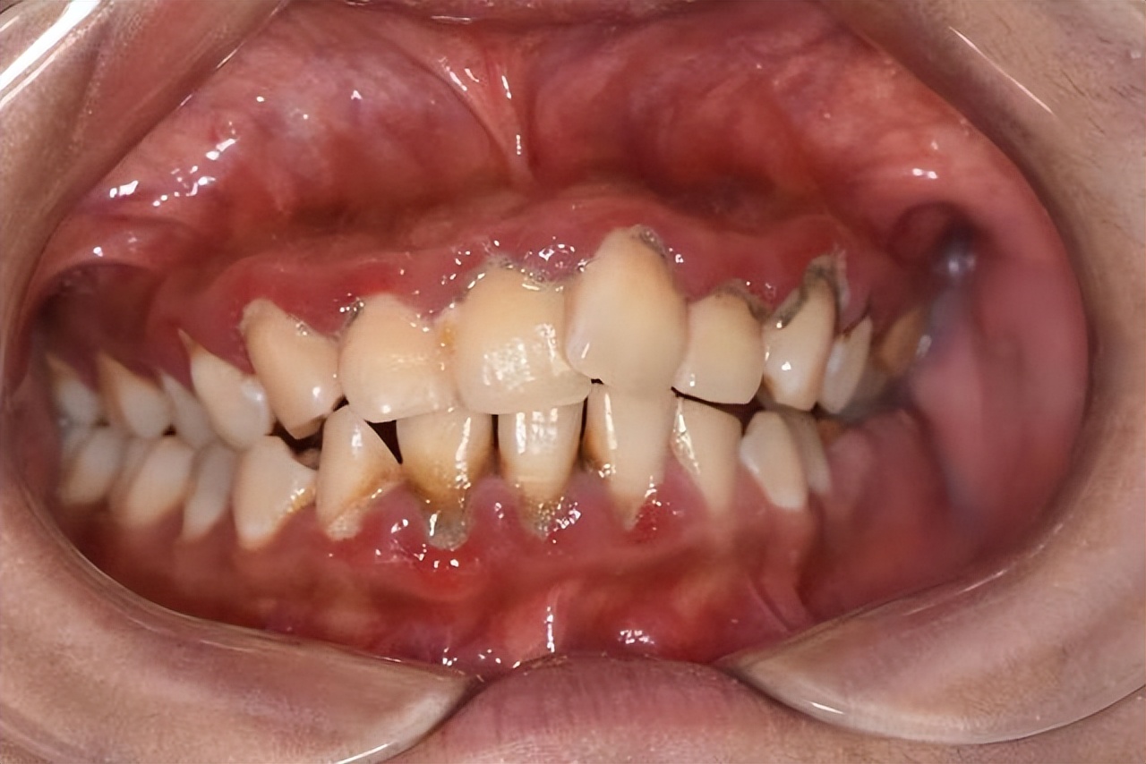 牙龈红肿发炎疼痛吃什么药,孩子牙龈红肿疼痛怎么办