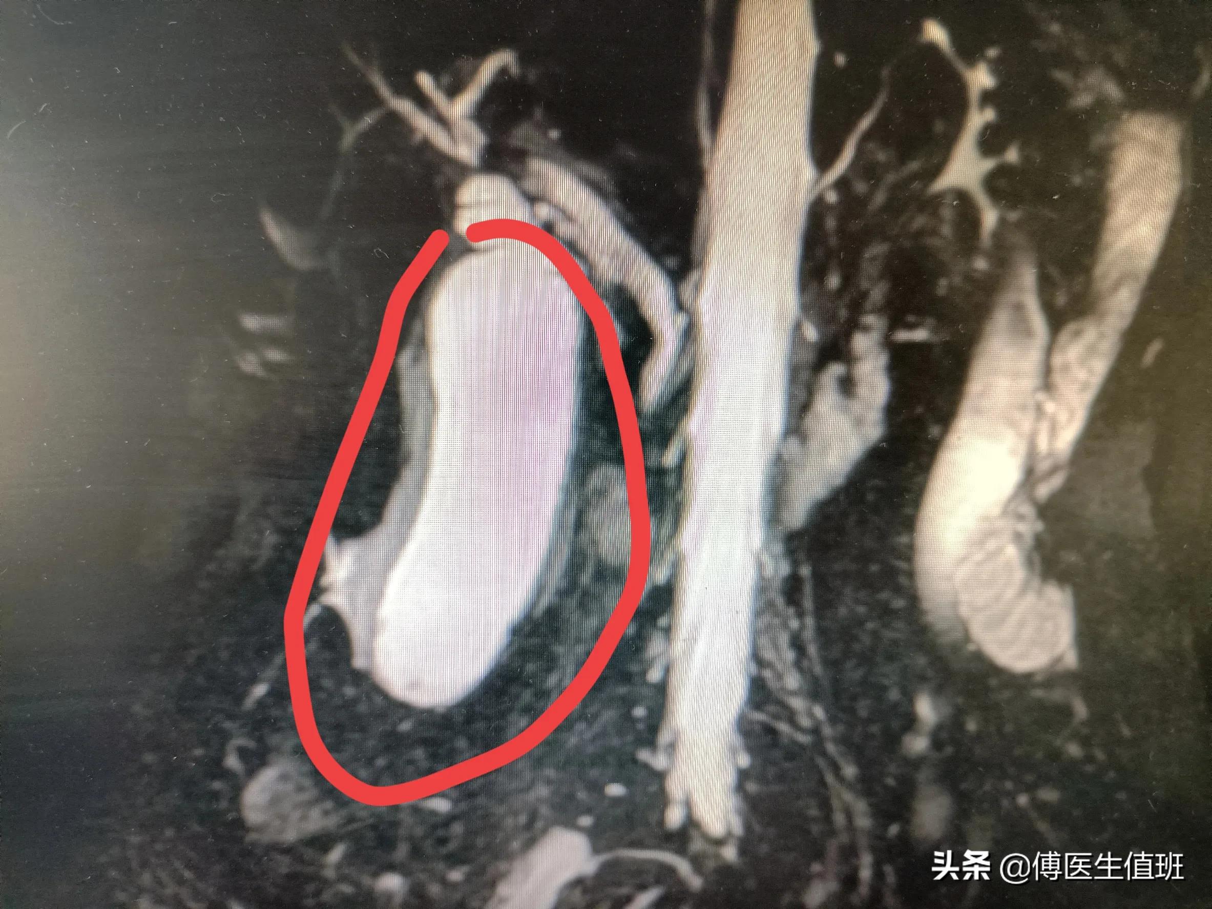女子长期饭后腹胀,女子饭后常感腹胀误以为是胃病