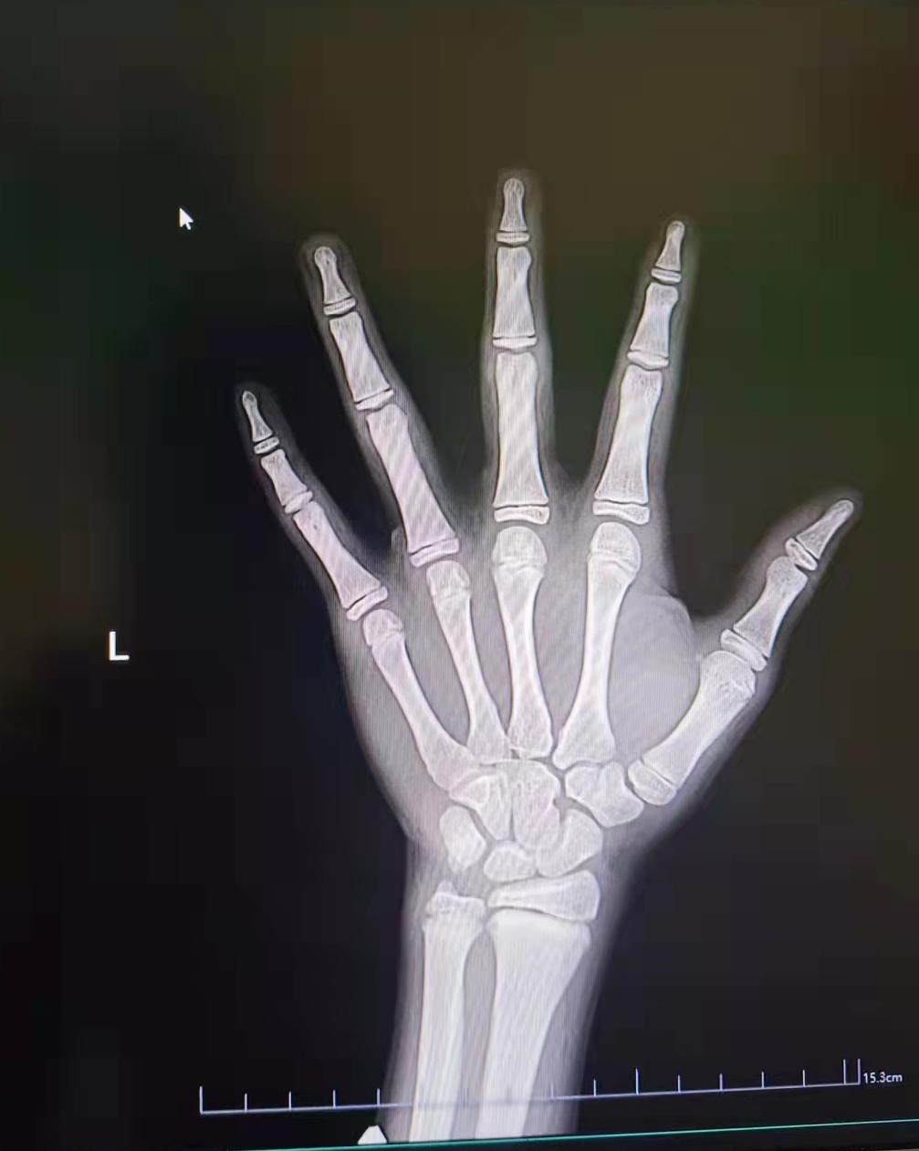 17岁女孩被警示,17岁早熟长高的科学方法