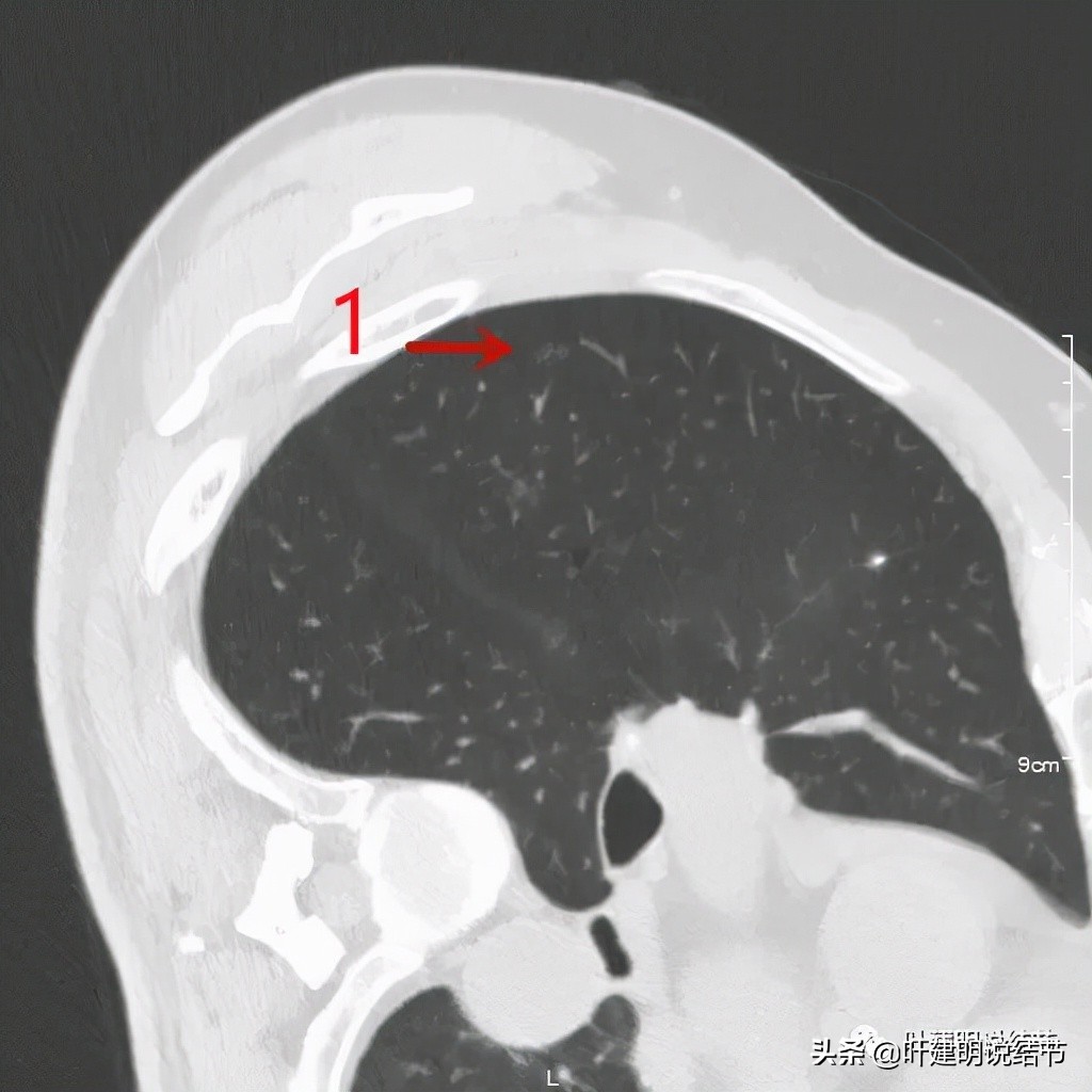 肺多发结节切除一个剩下的怎么办,无限纠结的肺小结节