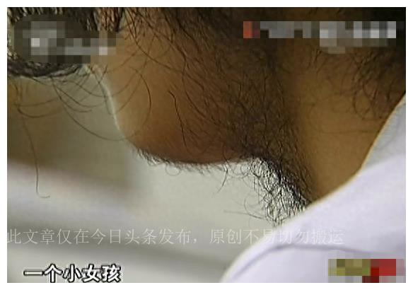 真实故事女子患怪病,真实事件女孩长胡子