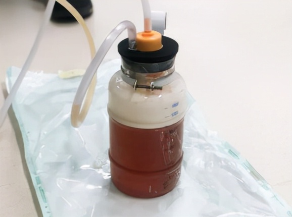 重庆一妇女肚子巨大,女子肚大如球竟是5颗肿瘤