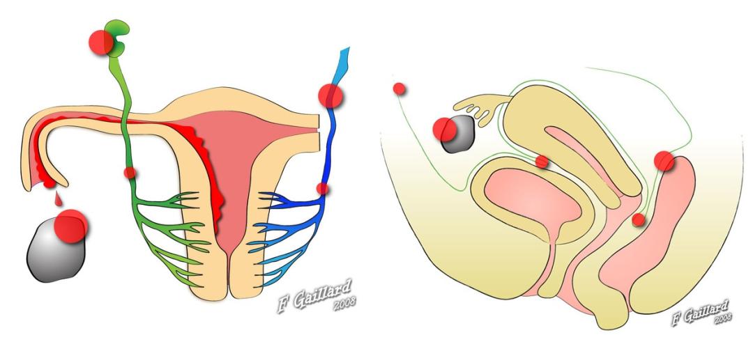 MRI如何评估子宫内膜异位症？这10个病例会帮助您