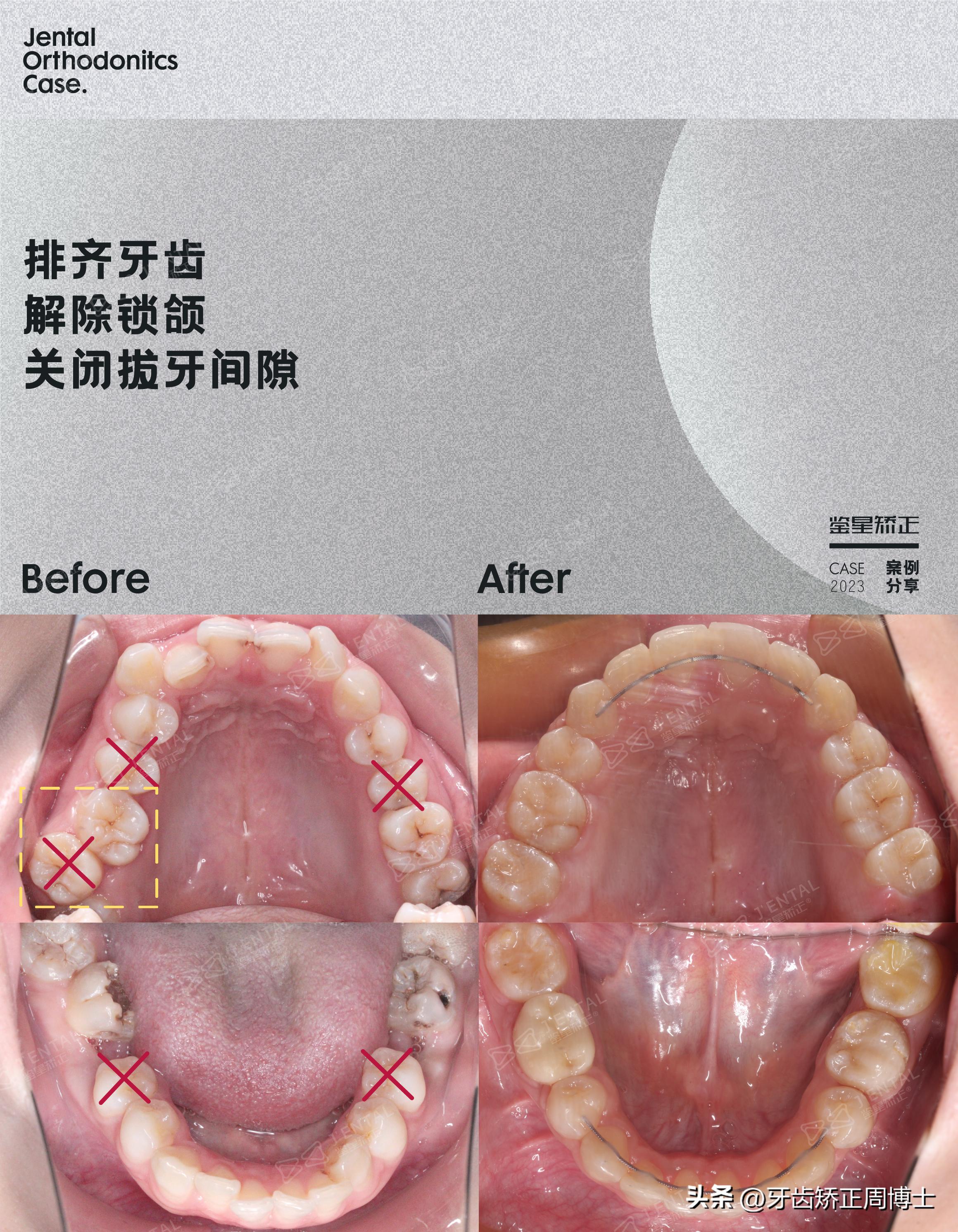 轻度拥挤龅牙咬合错位,龅牙导致牙齿咬合错位矫正价格