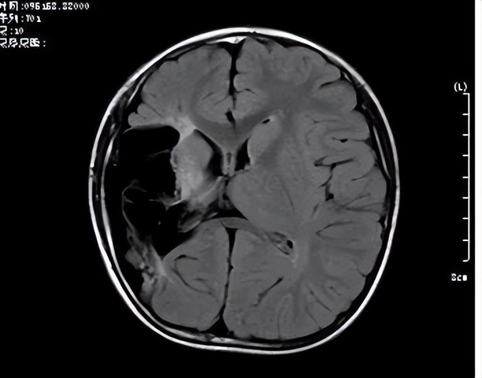 小儿偏瘫伴有癫痫怎么回事,男孩突然癫痫发作后续