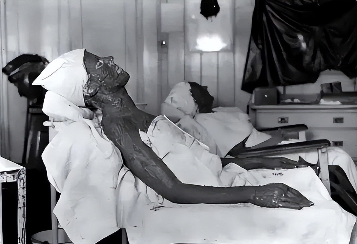 被镭辐射后的女工,核辐射后维持生命的工人