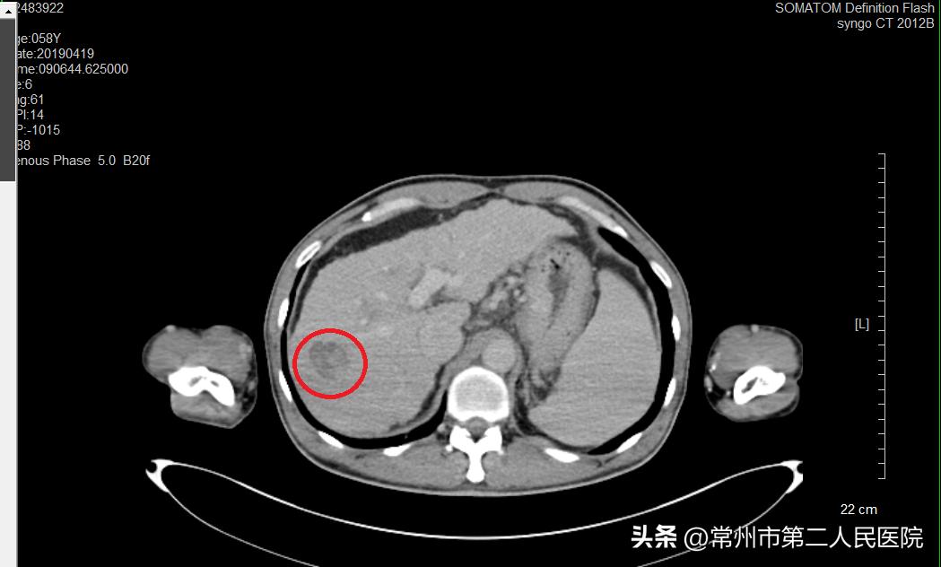 冷冻消融微创手术治肿瘤,精准微创治疗肿瘤