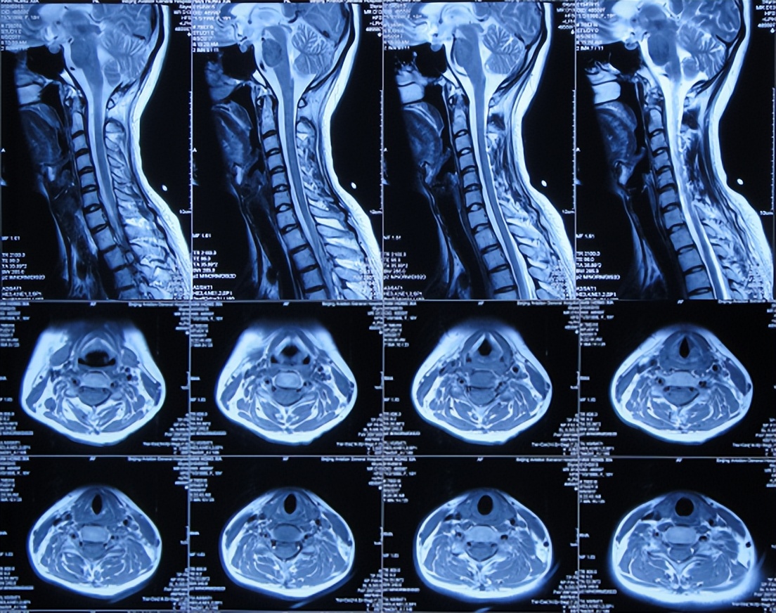 结核性脑积水能治愈吗,儿童结核脑膜炎脑积水