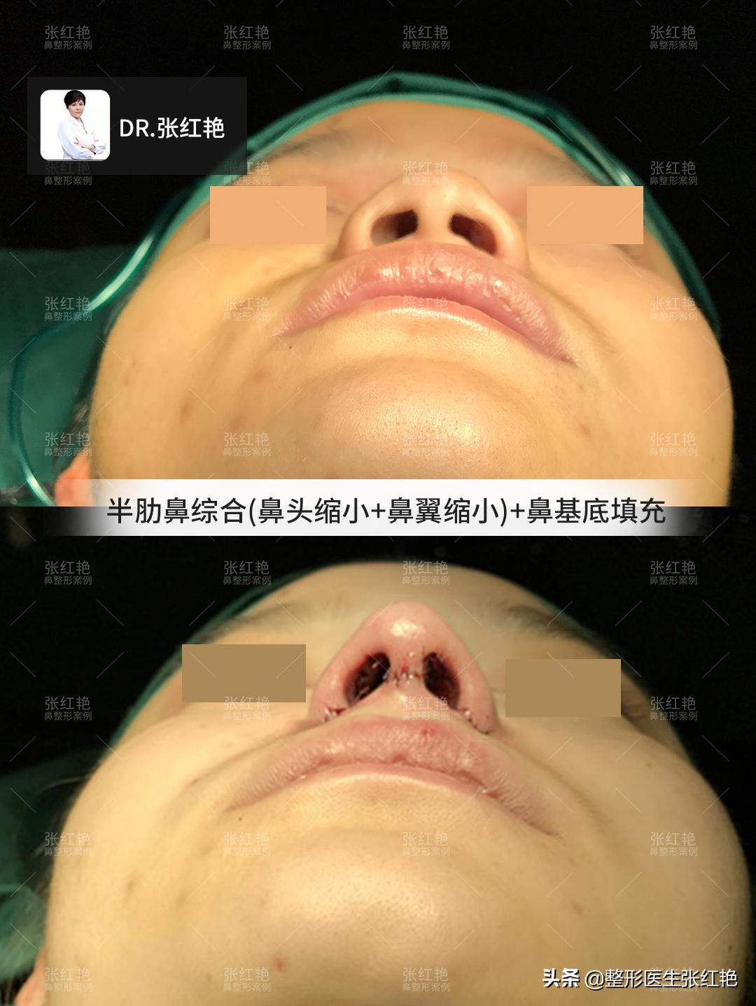 缩鼻翼怎么不留疤,缩鼻翼疤痕凸起