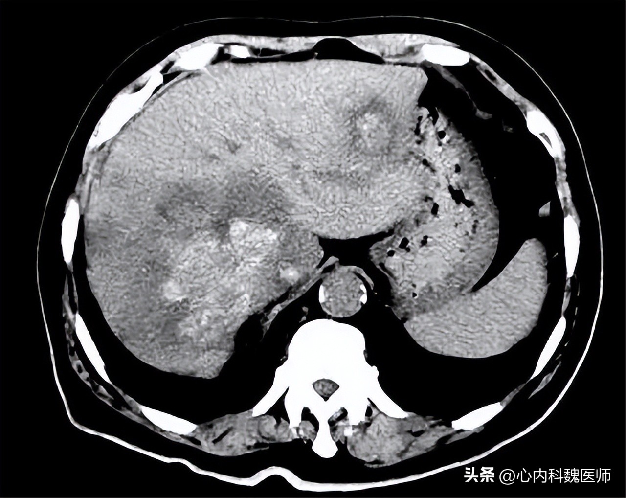 45岁男子吃3年恩替卡韦，却肝硬化了！医生：乙肝患者要注意3件事