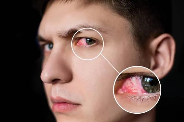 夏天得了过敏结膜炎能自愈吗,过敏性结膜炎小妙招