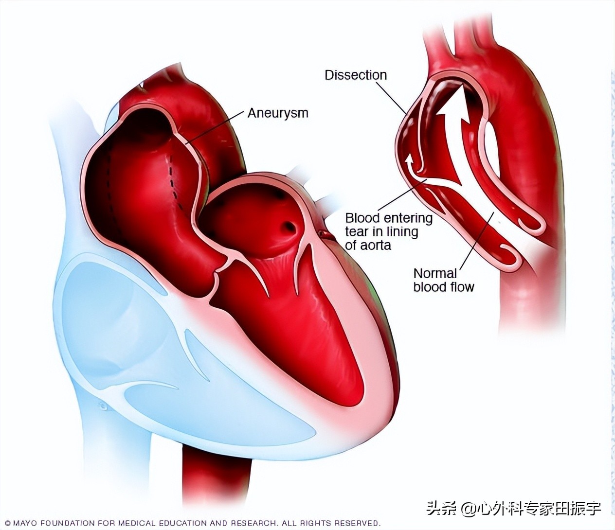 大动脉炎是血管出现了什么问题,大动脉炎是吃什么引起的吗