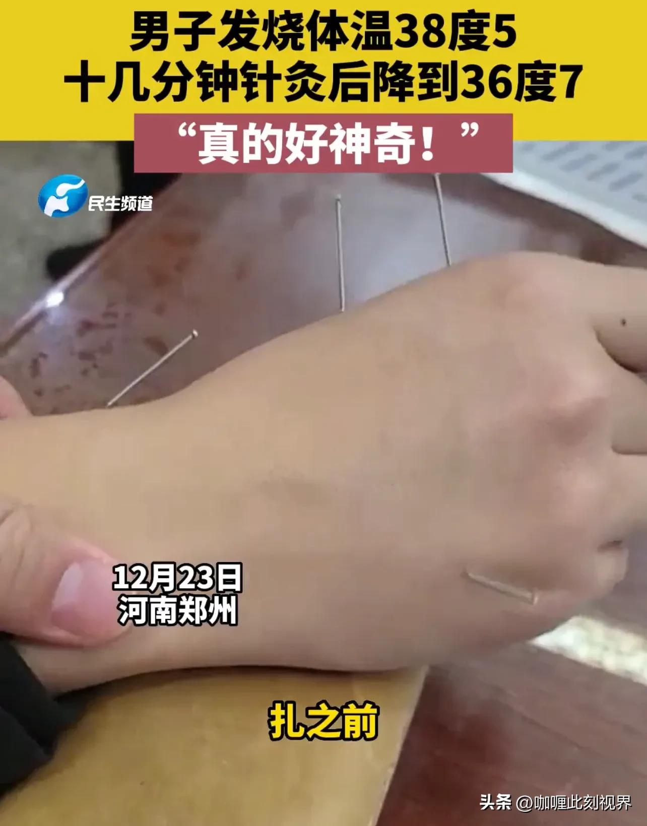 大人高烧可以通过针灸治疗,中医针灸治疗高烧反复