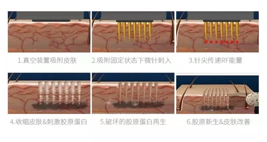 有什么方法能淡化妊娠纹呢,淡化妊娠纹用这个方法简单又实用