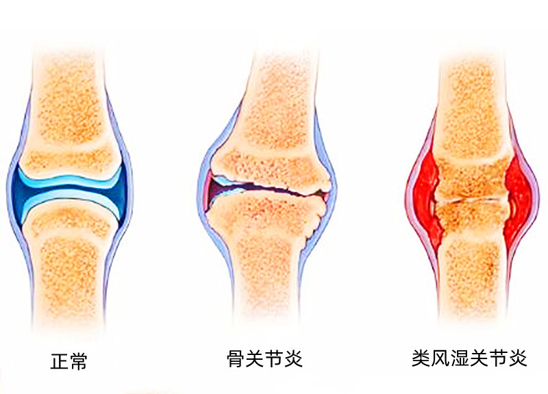 膝盖肿了一般是什么原因,怎么知道膝盖哪里出了问题